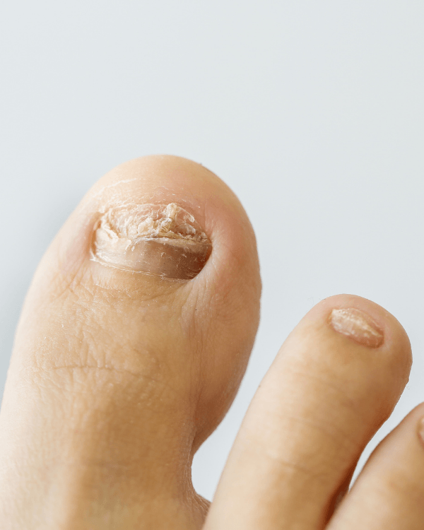 PORQUE TENHO MICOSE(ONICOMICOSE) NAS UNHAS? - Veuske